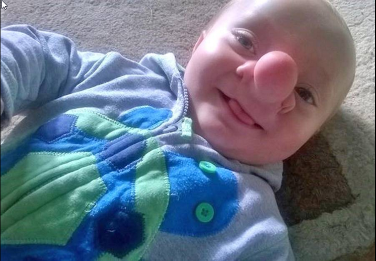 This baby has a birth defect, so his brain grows out out his nose.