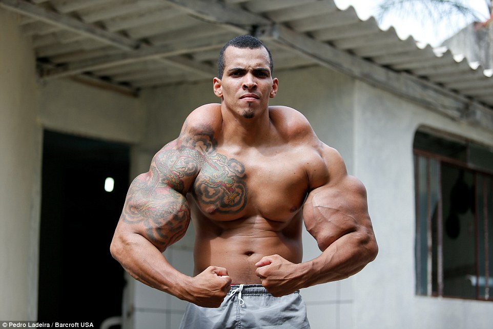 Romario dos Santos Alves is a Brazilian bodybuilding enthusiast, and injected oil into his arms in order to look like the Incredible Hulk: