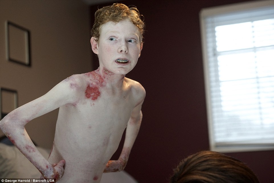 “The Butterfly Boy”, 14-year-old Jonathan Pitre, suffers from Epidermolysis Bullosa, a condition which makes his skin fall away at the slightest knock: