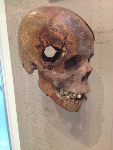 A skull from the Civil War. Fatal wound inflicted by exploding 12 pound artillery shell.