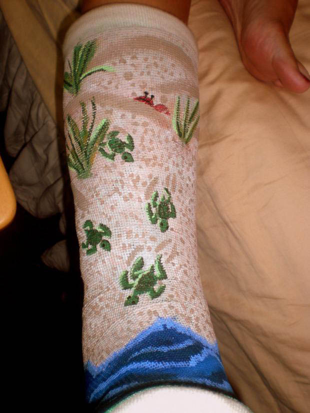 Arm And Leg Cast Artwork