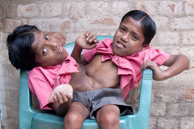 Conjoined Twins Who Are Worshipped In India