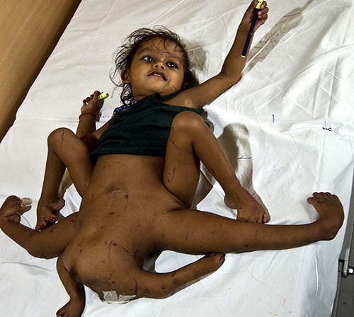 Eight limbed girl in India has since had corrective surgery