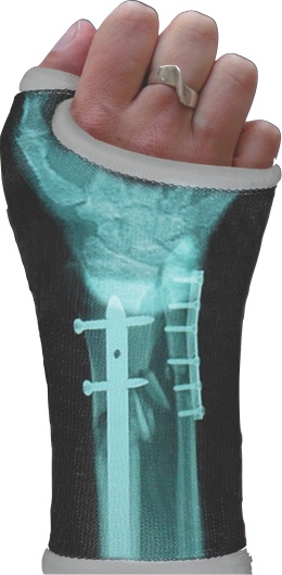 Send the digital copy of your X-ray to this company and they mail you a sticker of it to wrap around your cast