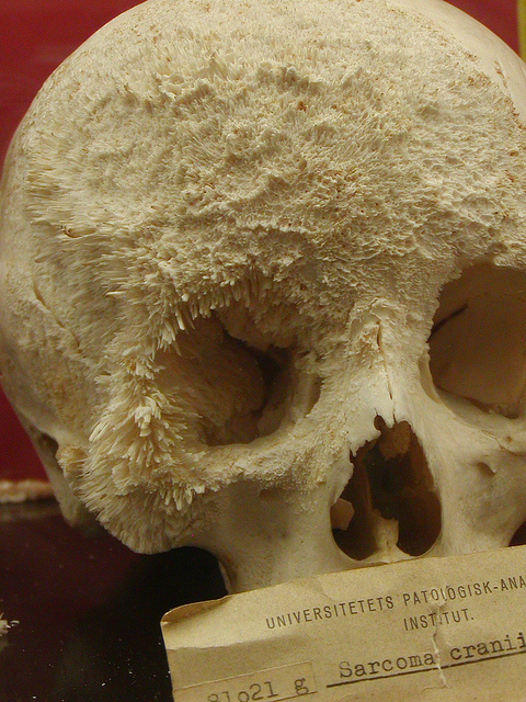 A human skull riddled with bone cancer