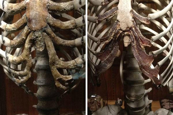 On the left, the rib cage of a woman who had become deformed after wearing a corset for many years. On the right is an average rib cage.