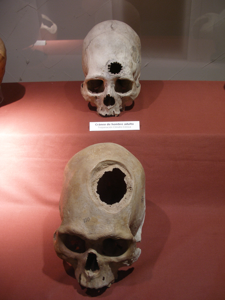 Evidence of brain surgery is shown in ancient Incan skulls. A piece of the skull was chipped out and the unhealthy part of the brain was removed. Then the hole was covered by a piece of metal. If you notice the thin layer of skull forming on the inner edges of the hole in the bottom picture... This bone growth signifies it allowed the person to live for several more months.