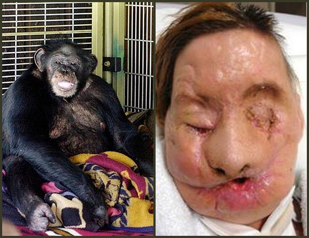In 2009, Travis the chimpanzee attacked his owner's 55 year old friend, Charla Nash. After seeing Nash holding one of his favorite toys, he lunged at her and latched onto her face. Herold, the owner, began stabbing Travis with a butcher knife. Travis was later found dead next to his cage. Nash lost her eyes, lips, hands, and mid-face bone structure in the attack, as well as recieving significant brain-tissue damage. As a result, she has since recieved a full-face transplant.