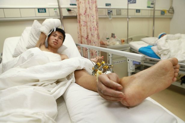 Man has his right Hand grafted to Leg