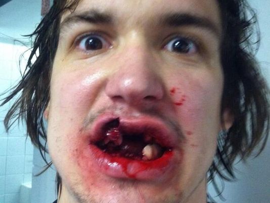 Mitch Callahan of the Grand Rapid Griffins AHL lost 10 teeth from blocking a shot