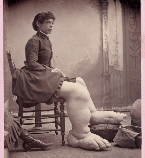 Fanny Mills: Also known as the Ohio Big Foot Girl, was born with Milroy disease, causing extreme swelling of the legs and feet. Her feet got to be 17 inches long before she died at the age of 39.