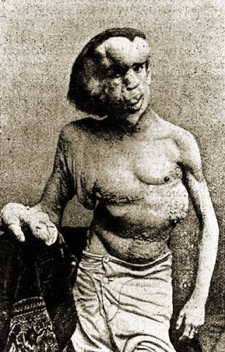 Joseph Merrick: Joseph, also known as the Elephant Man is an interesting case. He was born normal and only started noticing deformities when he was three years old in the form of bumps forming on the left side of his body. By the time he was 12, his deformities were severe and his father ended up kicking him out of the house, leaving Joseph homeless, hungry and alone.