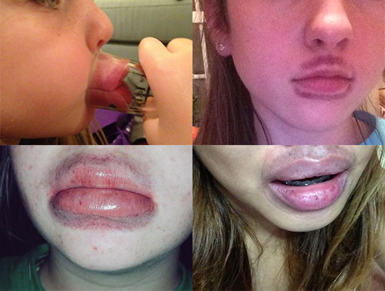Kylie Jenner Challenge:

The baby of the Kardashian-Jenner clan, Kylie is an 18-year-old superstar with looks that make guys want her, and women want to be her… Literally. This year saw the “Kylie Jenner Challenge” hit our newsfeeds, where women across the world would place their lips into a shot-glass (or something similar), and suck, in an effort to replicate Kylie’s bee-stung pout. However, to say the result were a disaster would be an understatement;