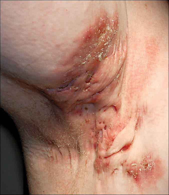 Hidradenitis Suppuratia. Inflammation of the sweat glands, usually in the armpits