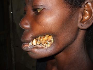 Cancrum Oris. AKA Norma Disease. Is a type of gangrene that destroys the mouth and face