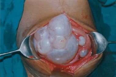 Echinococcosis. Another type of tapeworm that creates a cyst in the body, resulting in the picture above
