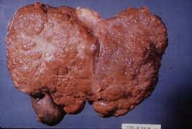 Your Liver after Hep C finished with it.