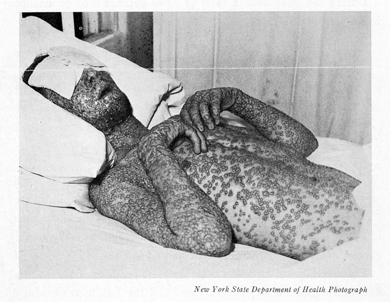 Smallpox. Very rare, but same situation as polio