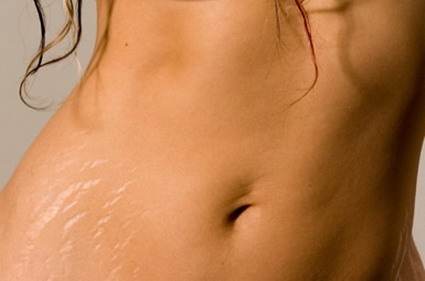 Stretch marks. AKA Striae They're the little faded marks on the lower left, right?