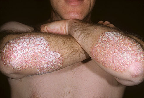 Psoriasis. Doctors aren't sure what exactly causes it, but its thought to be the bodies immune system mistaking healthy skin cells for enemies
