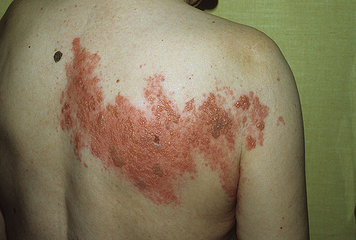 Shingles is caused by the same virus that causes chickenpox. HERPES VARICELLA ZOSTER