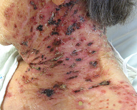 And can possibly get infected, like this