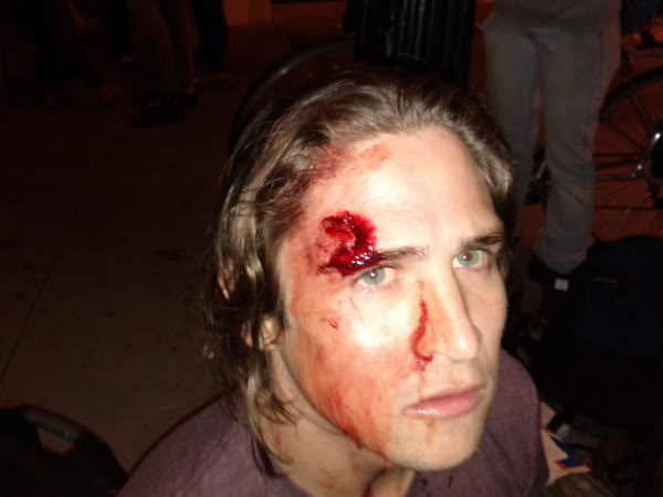 A bean bag to the forehead from a riot cop during a protest. Because this man needs to be "protected"
