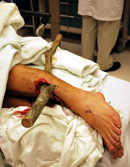 Mountain biking accident. Fake or not? I dunno.