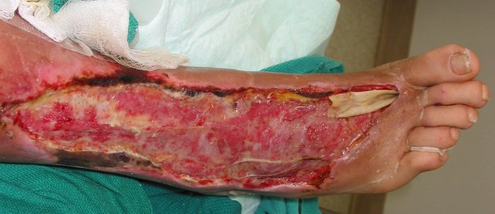 A flesh eating disease picture. Because these galleries aren't the same without it.