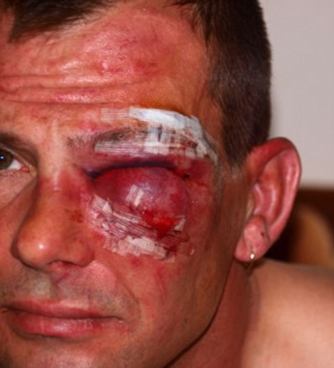 Boxers can lose their vision or even their whole eye when injures like this happen