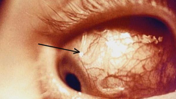 A teenager somewhere in the U.S. got a parasite in her eye thanks to her contact lens