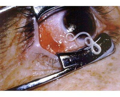 And this is a parasite being removed from the eye