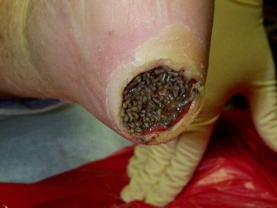 Apparently this is maggots being used as medicine for the wound...