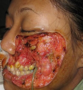 She got this after a small cut on her face got infected. All happened because she fell down.