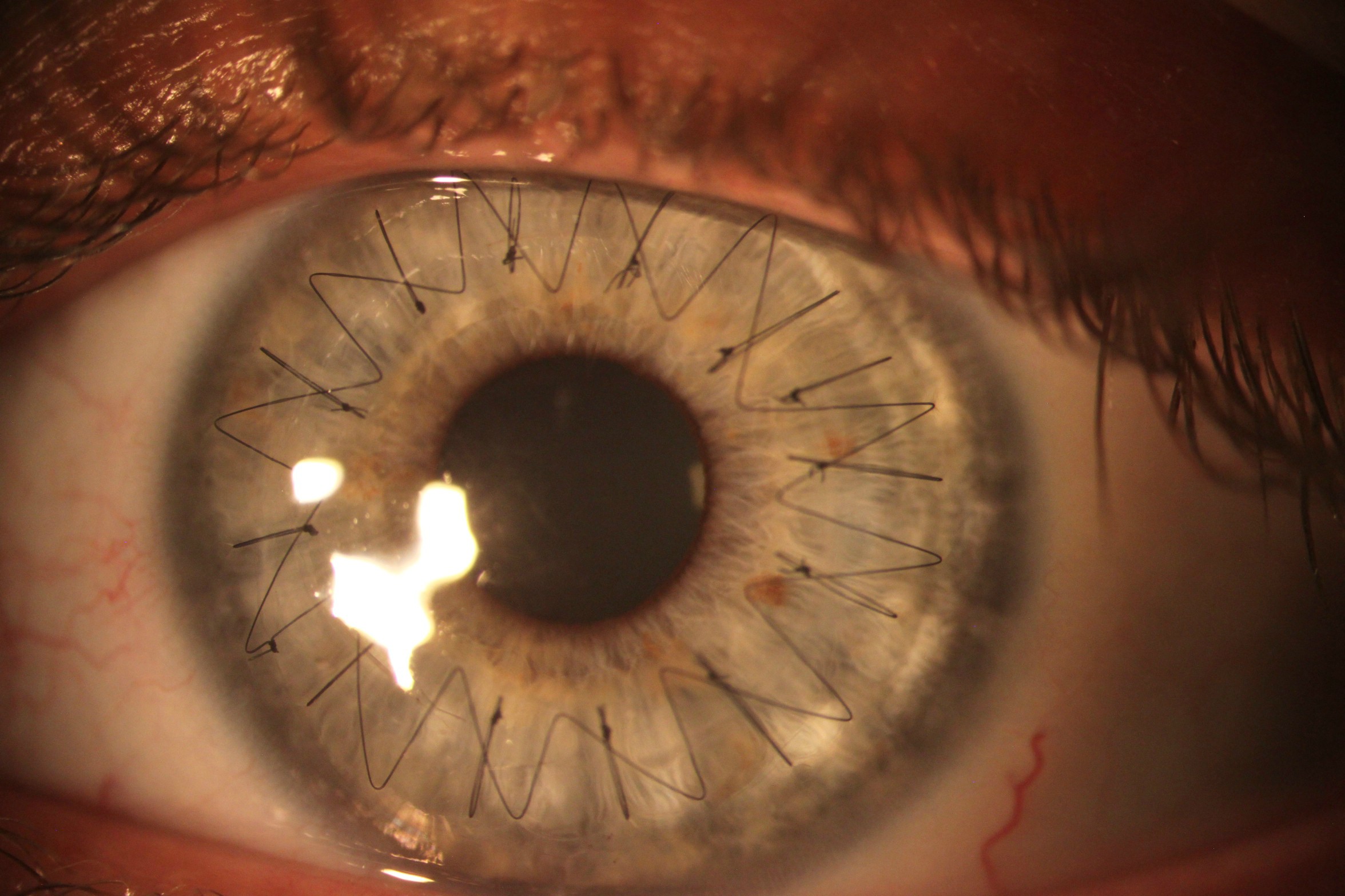 Stitches in an eye
