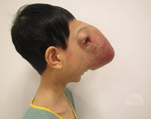 rare face deformity