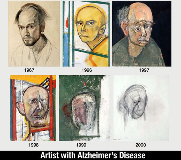 artist with alzheimer's self portrait - 1967 1996 1997 1998 1999 2000 Artist with Alzheimer's Disease