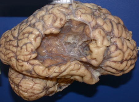 The brain of a stroke survivor