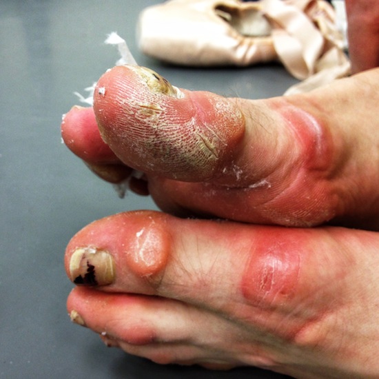 The ugly feet of a beautiful ballerina