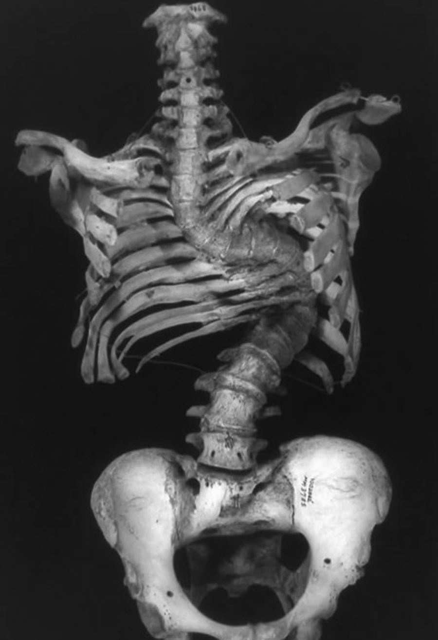 The spine of someone with untreated severe scoliosis