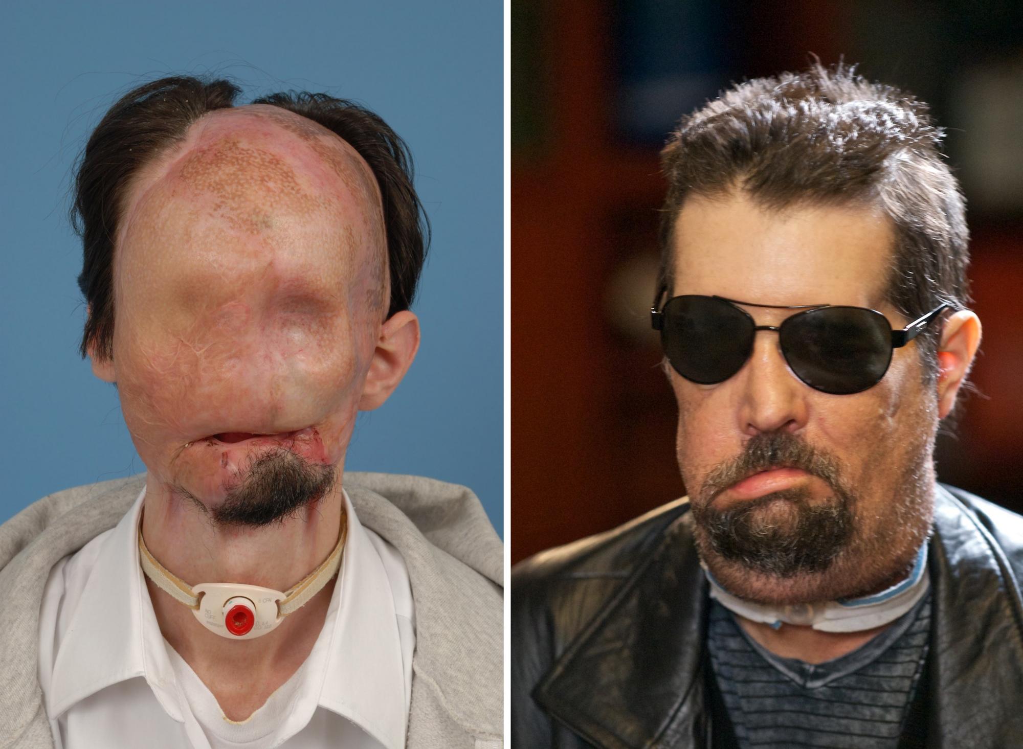 Dallas Wiens before and after full face transplant