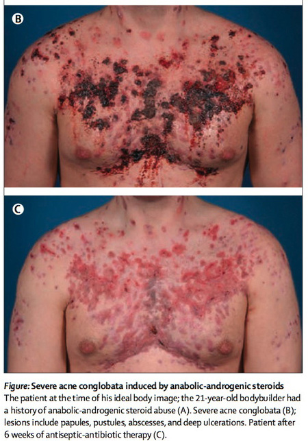 Severe acne induced by anabolic steroids