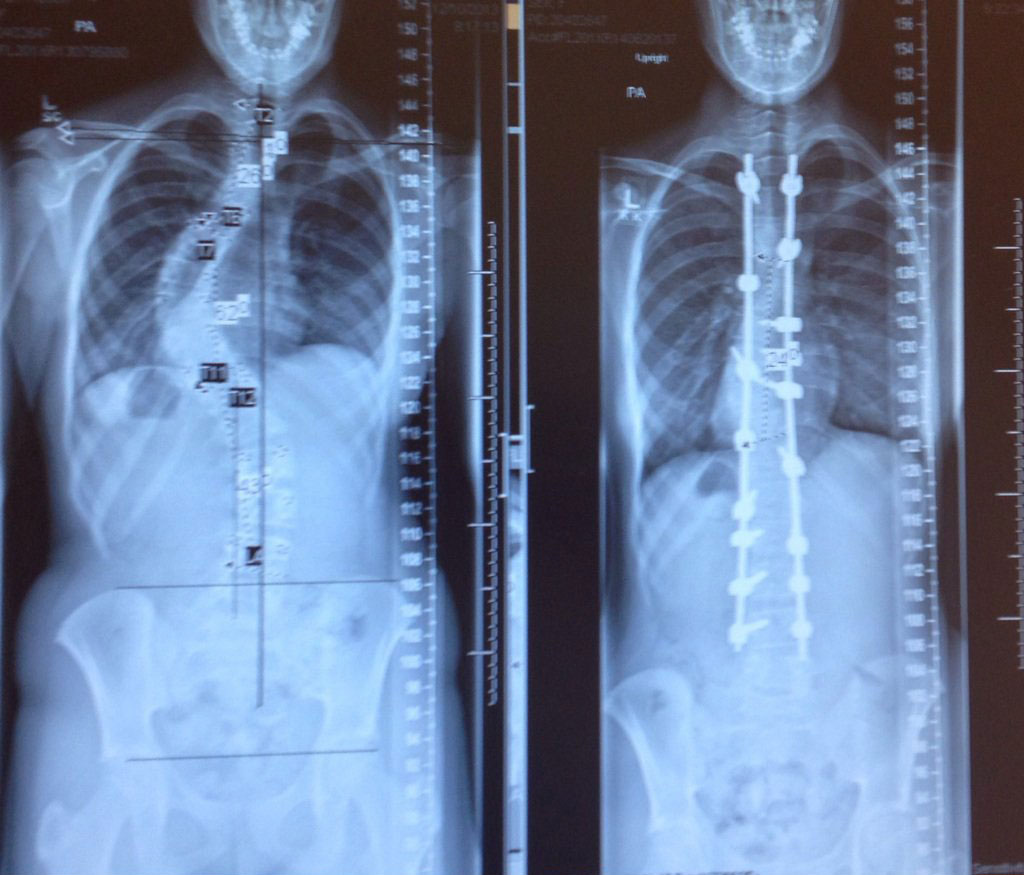 X-rays before and after a scoliosis treatment