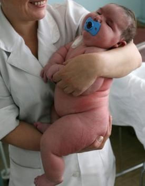 19-pound baby born in Indonesia