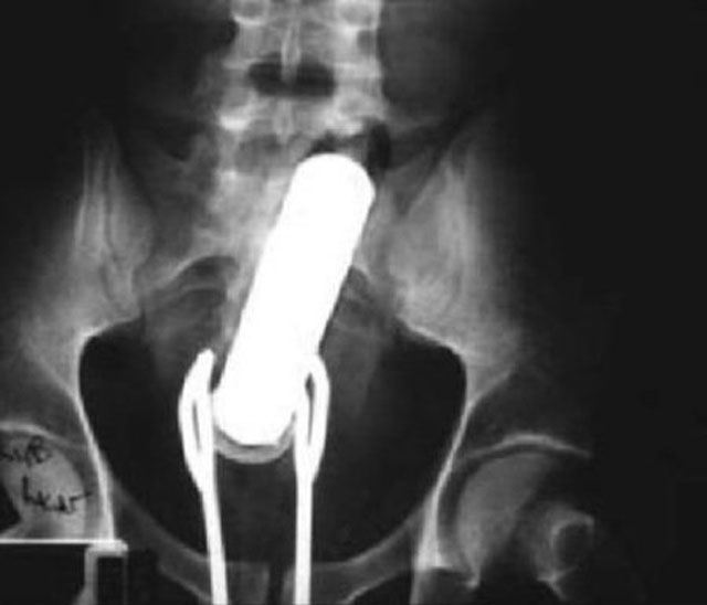Vibrator in the rectum. The patient attempted self-removal with a pair of salad tongs, which also became lodged.
