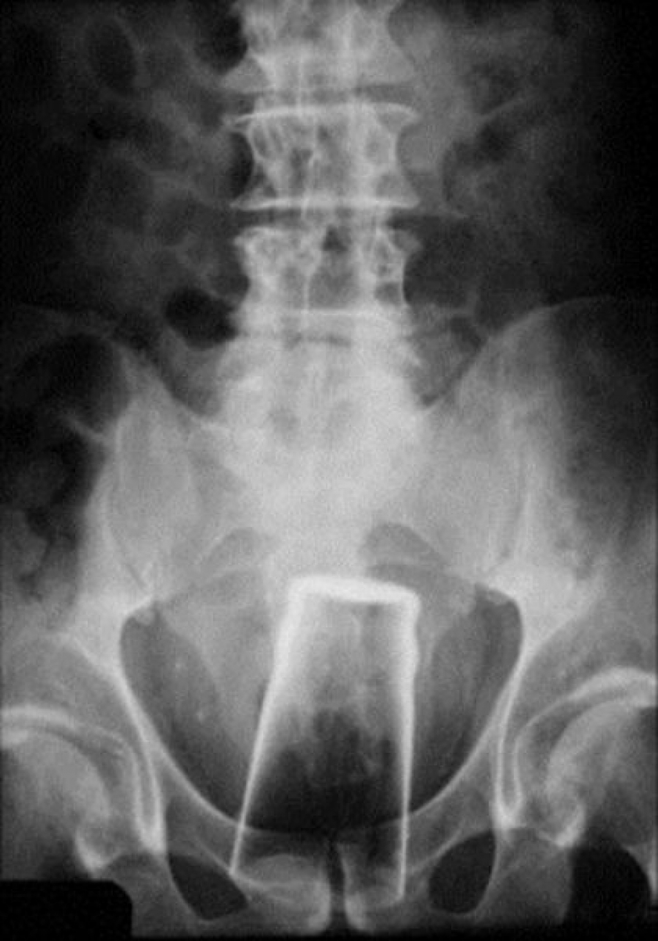 Инородное тело прямой кишки рентгенография