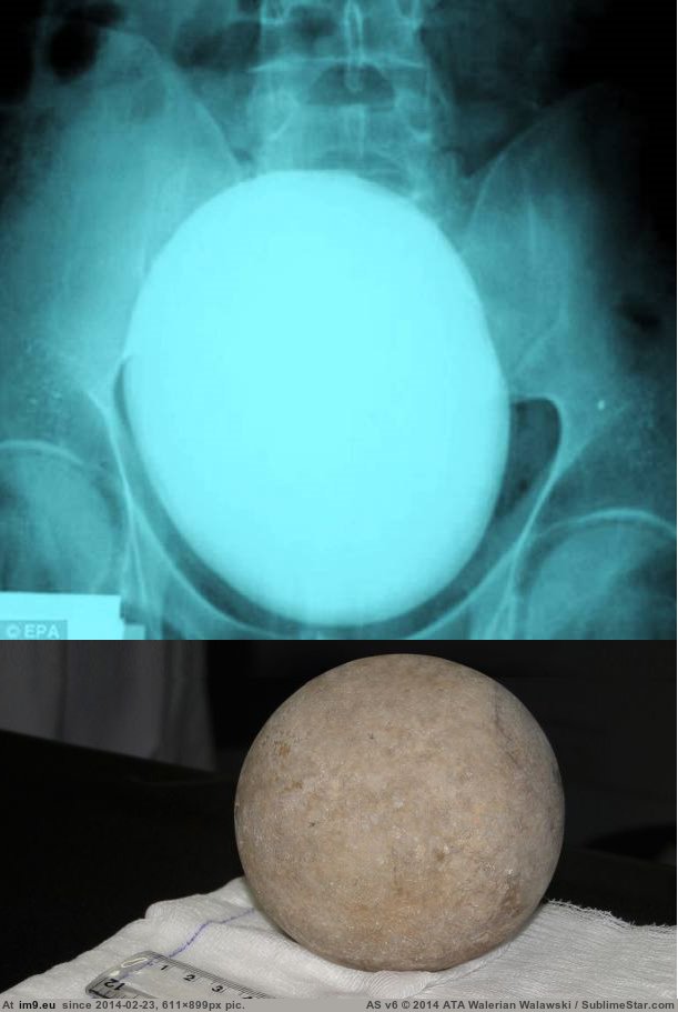 World record kidney stone, 700g 5"