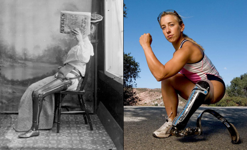 Left- Woman with an artificial leg, too embarrassed to show her face c. 1890 - 1900. Right- Sarah Reinertsen "born 22 May 1975" is an American triathlete and former Paralympic track athlete. She was born with proximal femoral focal deficiency, a bone-growth disorder, her affected leg was amputated above the knee at age seven.