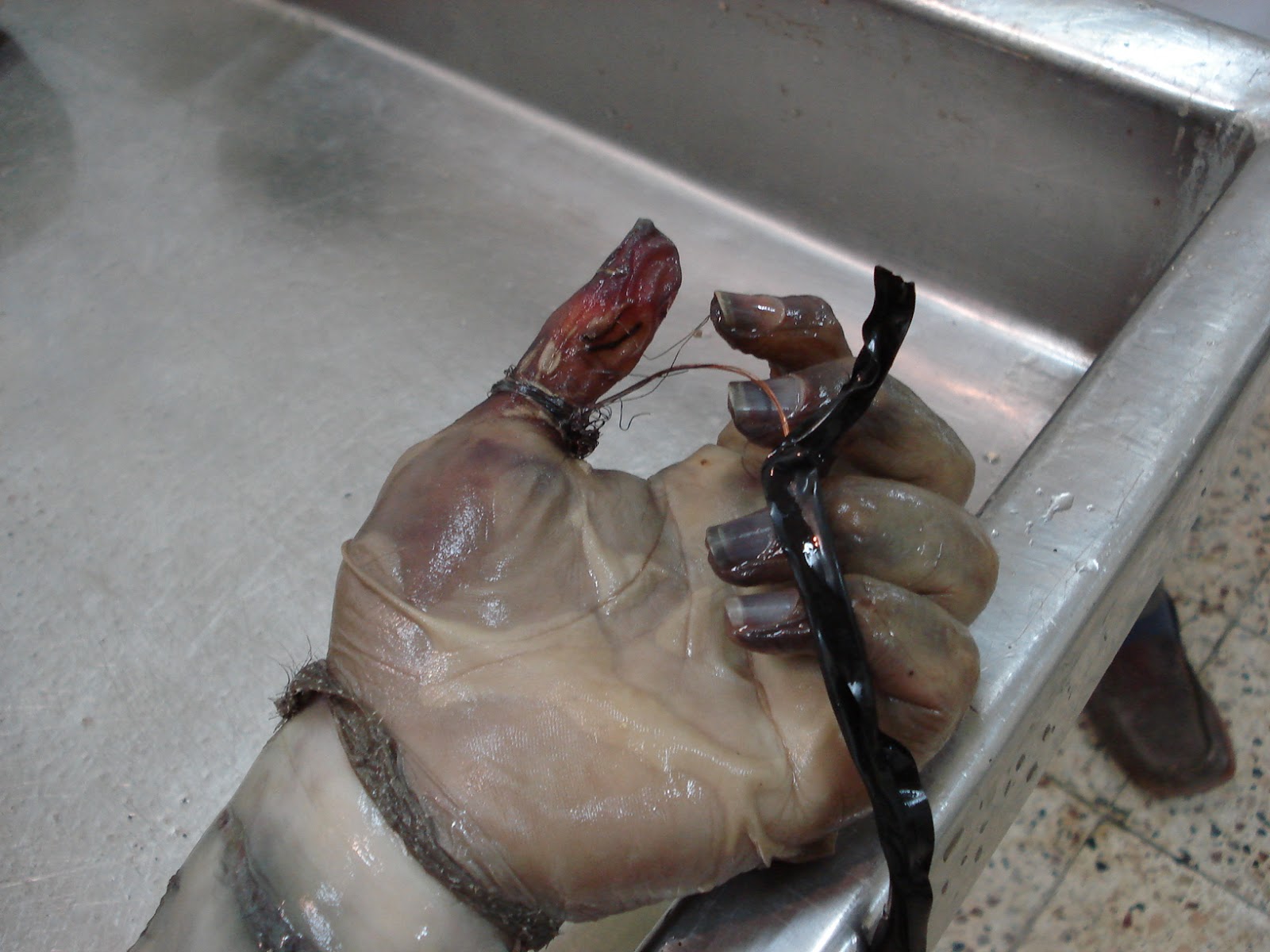 Hand of someone who committed suicide by electrocution