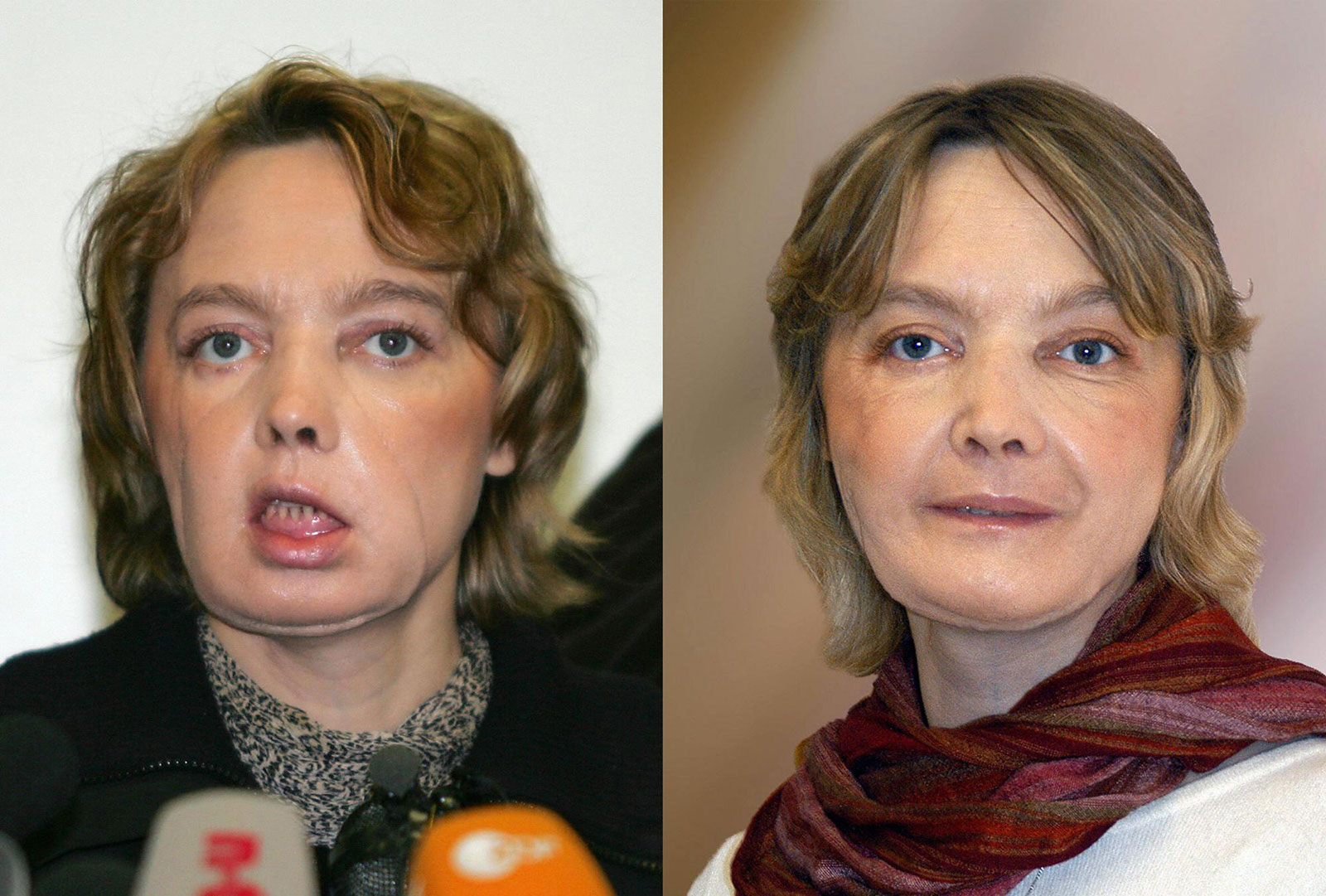Isabelle Dinoire after receiving the world's first partial face transplant. 2005